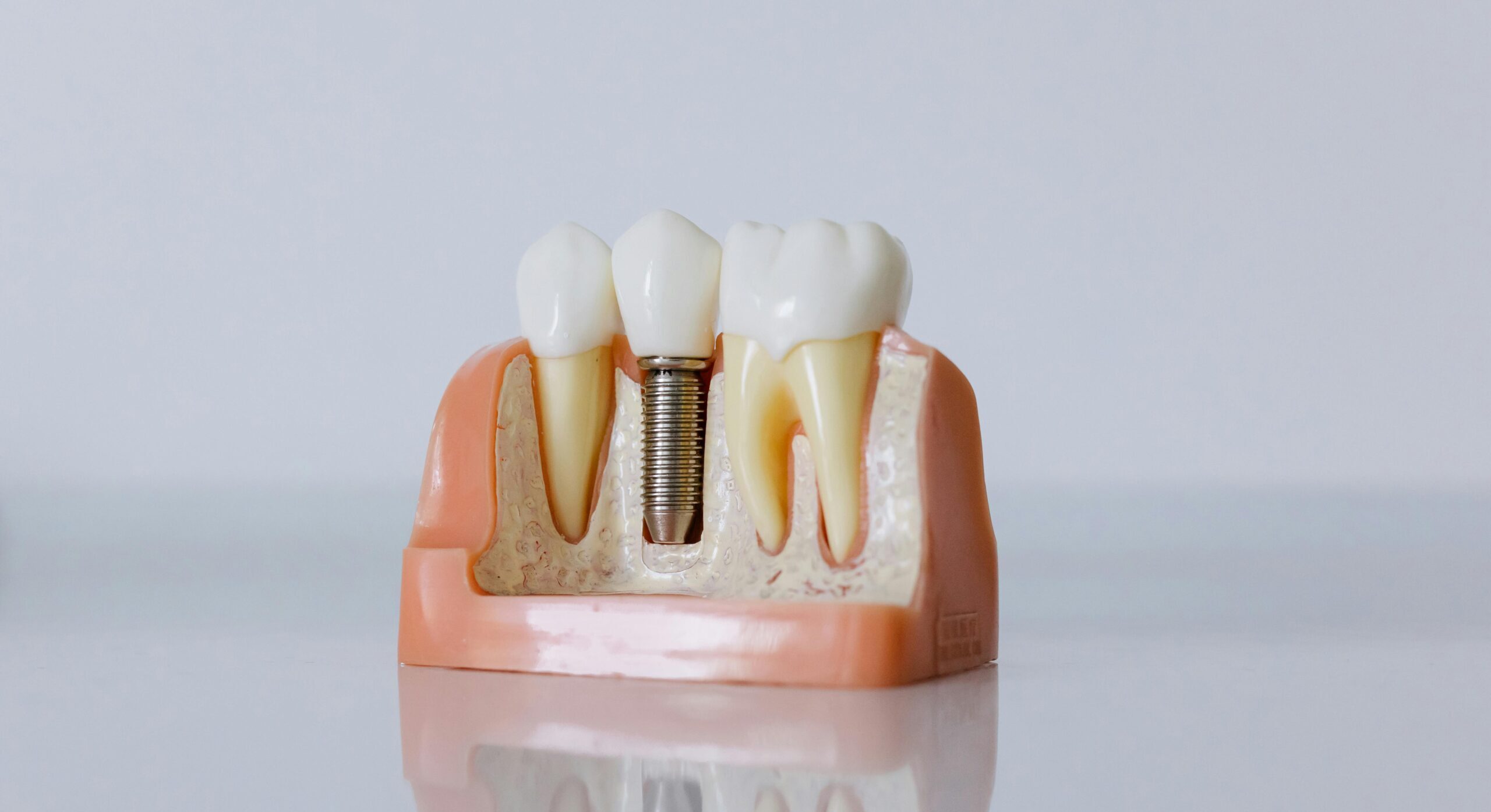 Detailed dental implant model showcasing teeth structure for educational purposes.